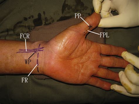 Flexor pollicis longus (FPL) tendoscopy of the left hand. The patient... | Download Scientific ...