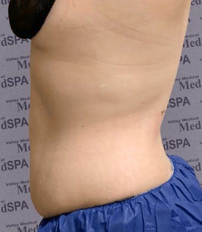 Laser Lipo Before & After Photos | Valley Medical Weight Loss