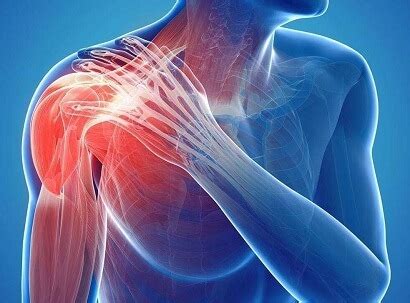 Shoulder Injury Diagram