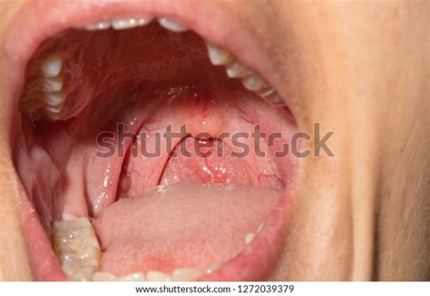 Sore Throat Throat Swollen Closeup Open Foto stock 1272039379 ...