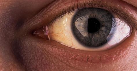 Yellow Eyes: Conditions That Cause in Newborns, Children, and Adults