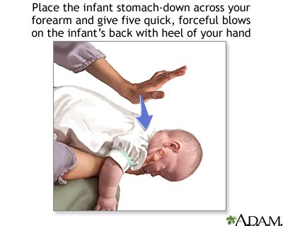 Choking first aid - infant under 1 year - series—Part 1: MedlinePlus ...