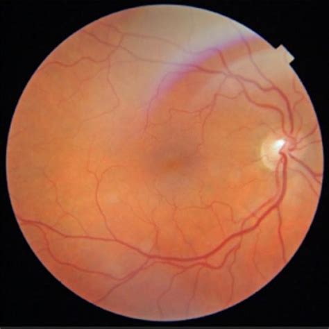 Cystoid macular edema: all what you should know blog