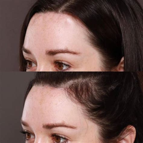 What to Know Before Getting Forehead Reduction Surgery - Utah Facial ...