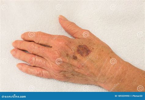 Red Bruises On Elderly Skin