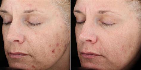 Illuminize Peel Before And After Photos - Draw-heat