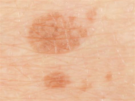 Brown Patches Suddenly Appearing On Skin - Printable Templates Protal