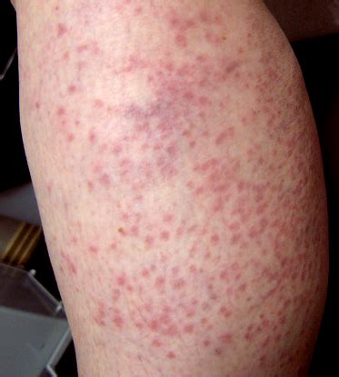 Maculopapular Rash - Pictures, Symptoms, Treatment, Causes