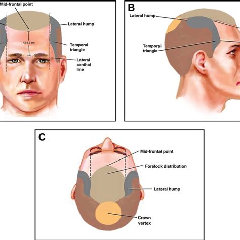 Surgical anatomy of the scalp. (A) Frontal view emphasizing the level... | Download Scientific ...