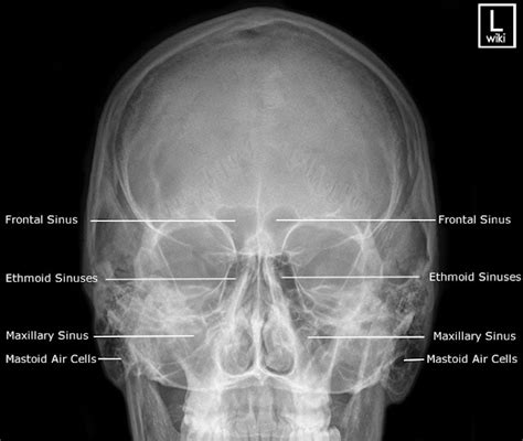 Mundo da Radiologia: Incidências PA Caldwell