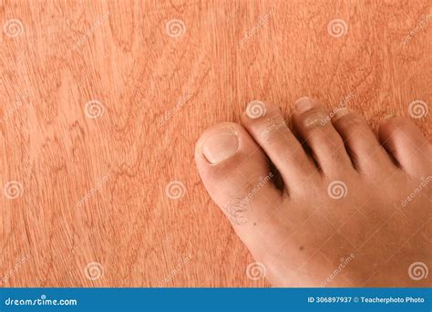 Athlete S Foot, Medically Known As Tinea Pedis, Fungal Infection Affecting the Skin of the Feet ...