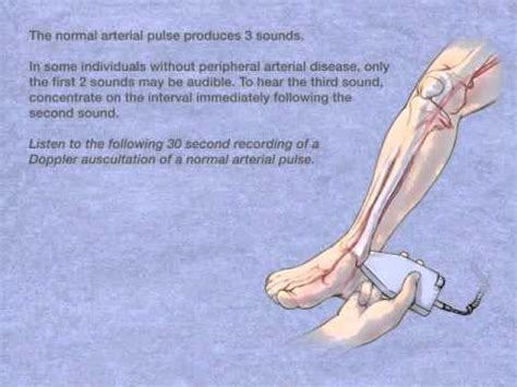 Doppler Auscultation of the Posterior Tibial Artery - YouTube