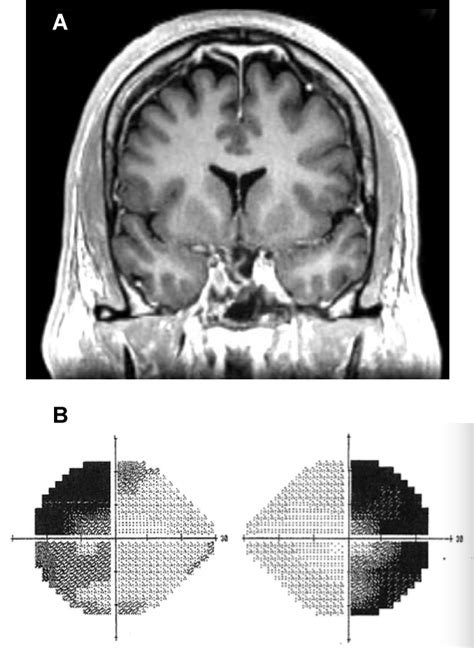 Vision Loss Due to Herniation of the Optic Chiasm | Duke Health ...