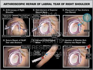 Right Shoulder Arthroscopic Capsulorrhaphy with Bio-SutureTak Repair of Labral Tear - Print ...
