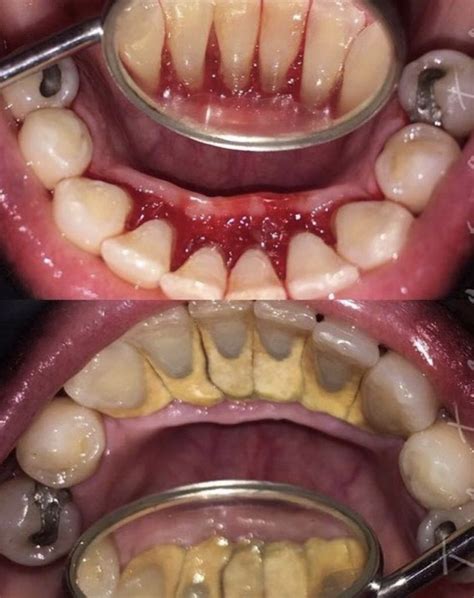 This is extreme before and after pic of calculus removal. | Mouth ...