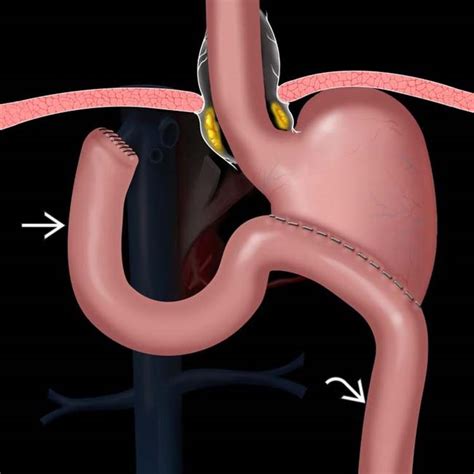 Partial Gastrectomy: Bilroth Procedures | Clinical Gate