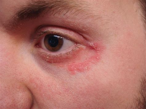 Eyelid Infection