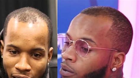 Tory Lanez Hair Transplant - Hair Analysis by Matt Dominance