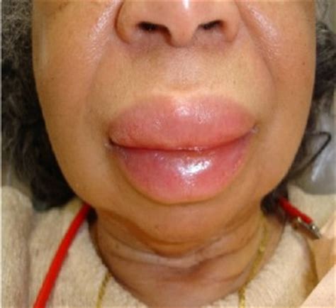 Angioedema Symptoms, Causes, Diagnosis and Treatment - Natural Health News