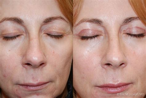 Eric M. Joseph, MD | Eyelid Surgery Gallery