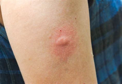 Mosquito Bite on Humans: Pictures and Tips