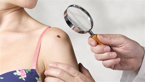 'Save your Skin', the skin cancer prevention campaign - Breaking Latest ...