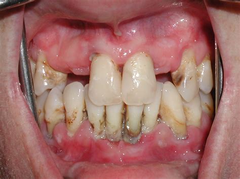 Periodontal Disease Progression Dentalfacts Periodont - vrogue.co
