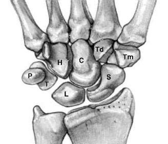 Hook of Hamate Fracture - Hand - Orthobullets