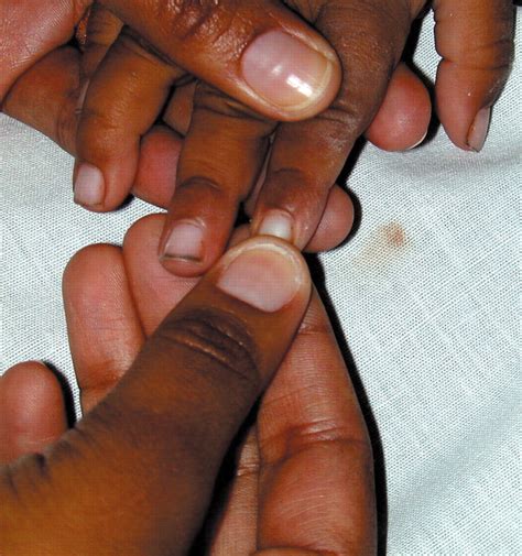 Capillary refill: prognostic value in Kenyan children | Archives of ...