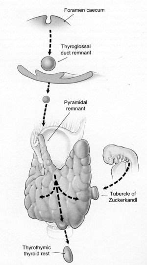 Ectopic Thyroid - Endocrinesurgery.net.au | Thyroid, Disease, Duct