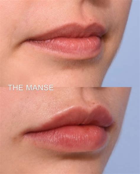 Lip Anatomy with Ageing - Best Clinic Sydney for Dermal Fillers