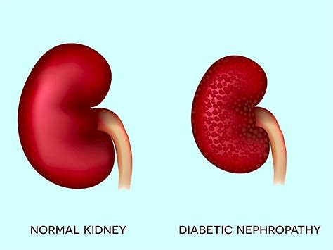 Diabetic Nephropathy: Causes, Symptoms & Treatment » How To Relief