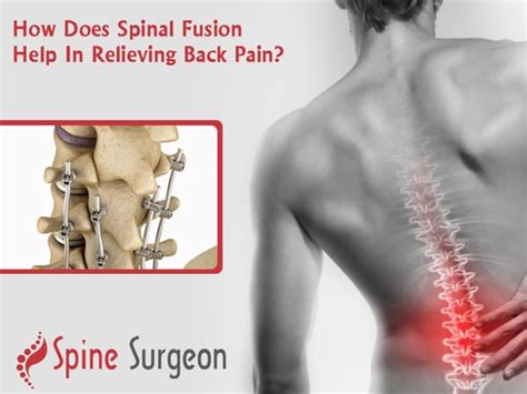 How Does Spinal Fusion Help In Relieving Back Pain? | Spine Surgeon