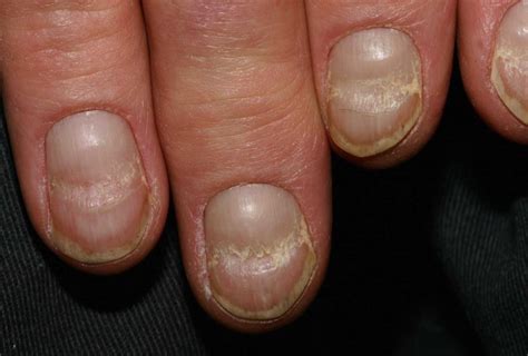 Chronic Iron Deficiency Anemia Changes Your Nails