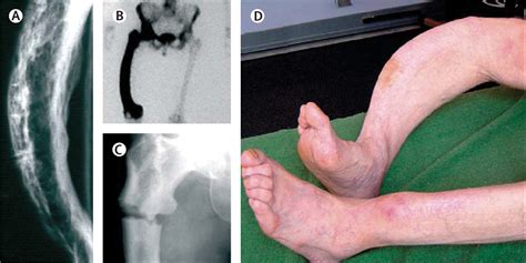 Pathogenesis and management of Paget's disease of bone - The Lancet