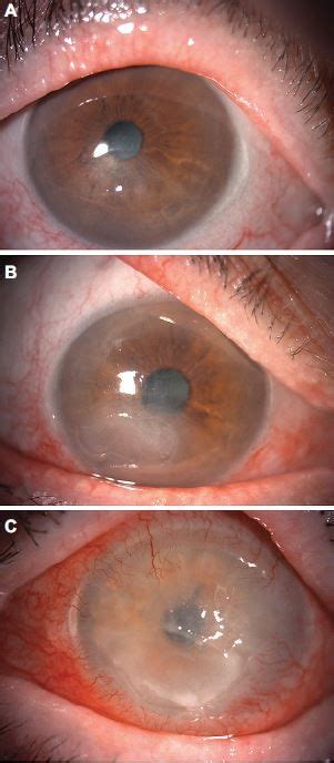 Neurotrophic keratitis: current challenges and future prospects | EB