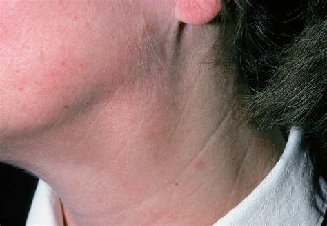 Lymph Node Lump On Neck