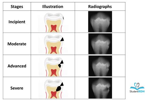 Must-know classifications of Dental Caries for the National Dental Hygiene Boards - StudentRDH Blog