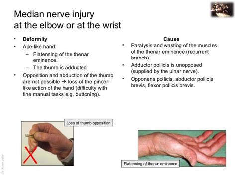 Applied anatomy median nerve injury