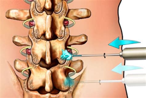 Rhizotomy - Interventional Spine & Surgery Group