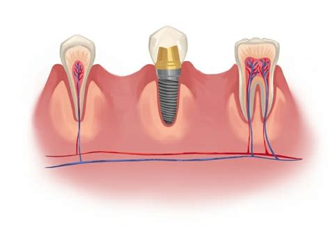 Infected Root Canal Symptoms | by Symptom Finder | Jun, 2023 | Medium