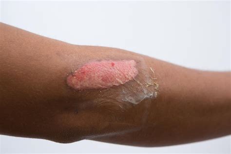 Second-degree burn: Causes, symptoms, and treatment