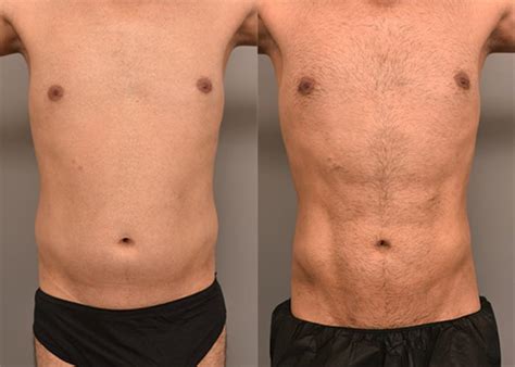 Liposuction for Men Before and After Photo Gallery | New York, NY | Thomas P. Sterry, MD