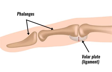 Volar plate injury - Symptoms, Causes & Treatment.