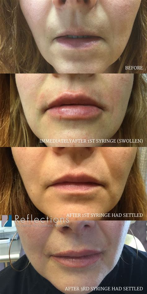 Multiple syringes of lip filler requires time to build up, especially when you want to change ...