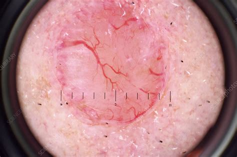 Trichoblastoma examination - Stock Image - C040/1002 - Science Photo ...