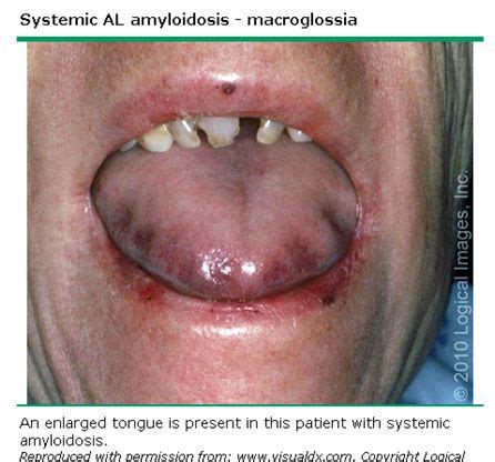 SFP: Amyloidosis Flashcards | Quizlet