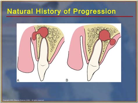 Odontogenic infections