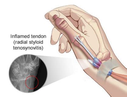 Radial Styloid Tenosynovitis Treatment Doctors in Brooklyn NYC