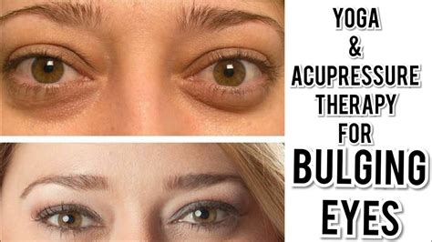 Eye Exercises & Accupressure Therapy for Bulging Eyes or protruding eyeballs due to ...